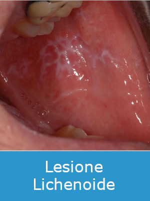 Lesione Lichenoide